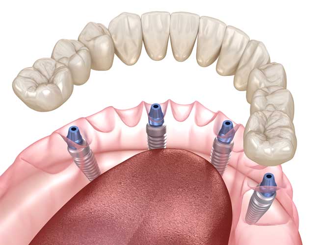 All-on-4 Dental Implants for Full Teeth Replacement