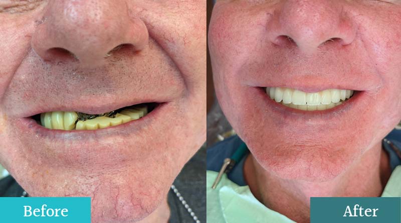 Full Mouth Dental Implants Before & After