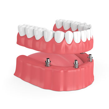 implant-supported-denture
