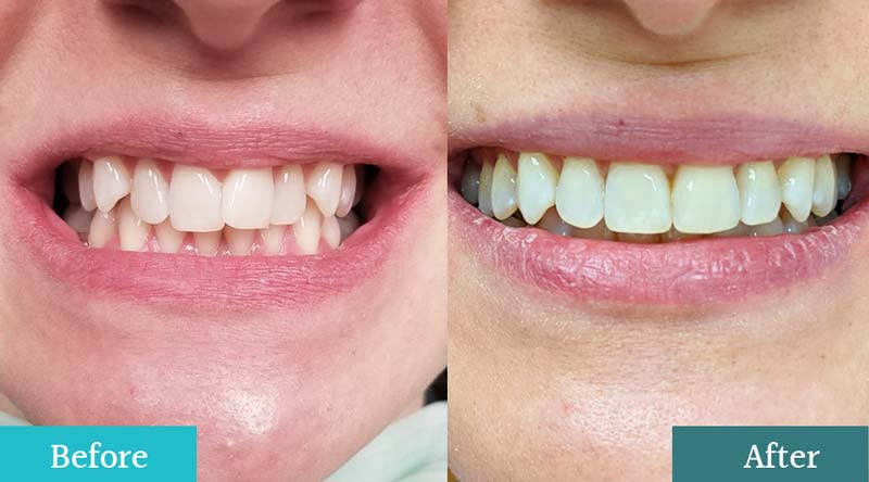 Invisalign Before & After Patient