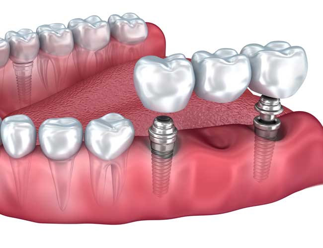 Multiple Tooth Replacement Dental Implant Bridge