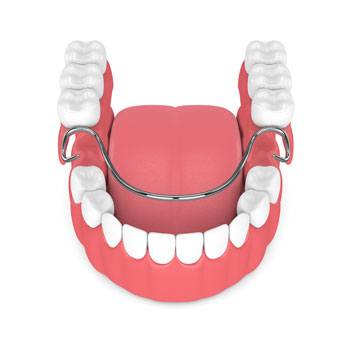 Partial Removable Denture