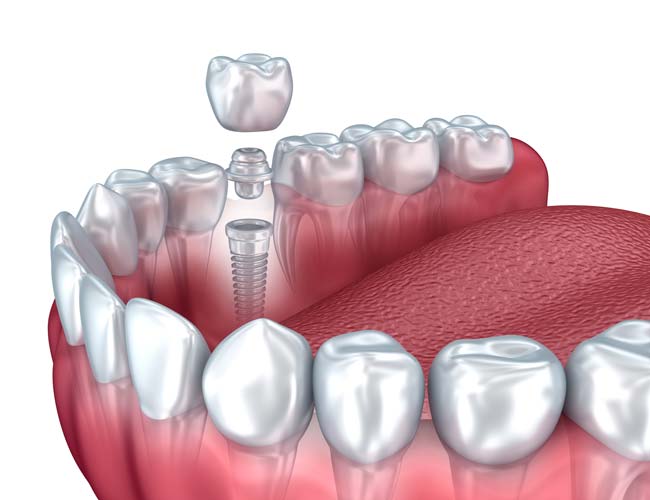 Single Tooth Replacement Dental Implant