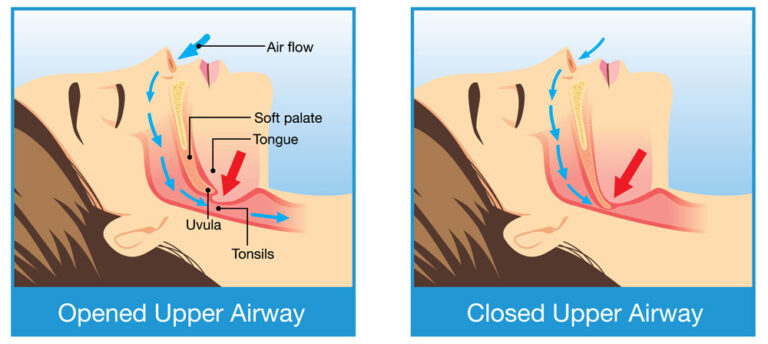 Sleep Apnea Treatments from Dentist - Jericho Dental