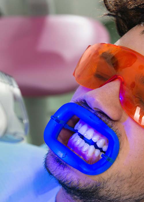 Professional Teeth Whitening at the Dentist